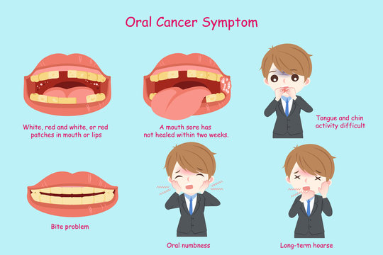 oral cancer